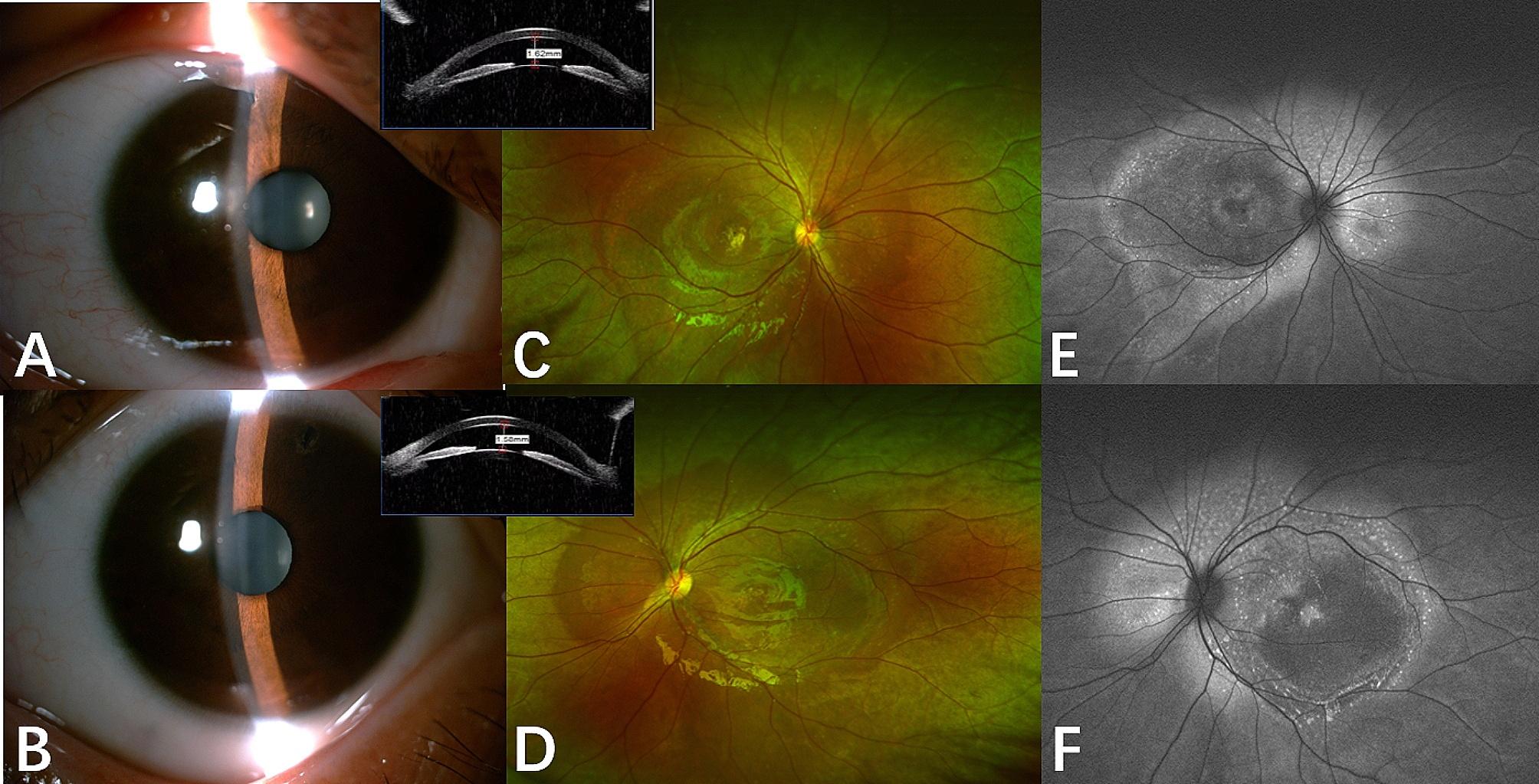 Six panels from one patient with ARB. Two slit-lamp photographs show a shallow anterior chamber, with anterior segment OCT insets measuring the depth. Two widefield fundus photographs show many small yellow deposits over the posterior pole and around the optic disc. Two autofluorescence images show the posterior pole bright.