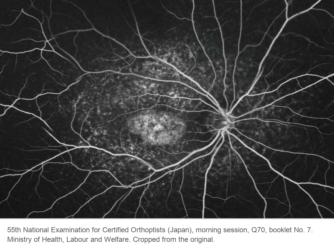 Fluorescein angiogram of the same patient: the retinal vessels stand out against a dark background, with bright flecks around a bright macula