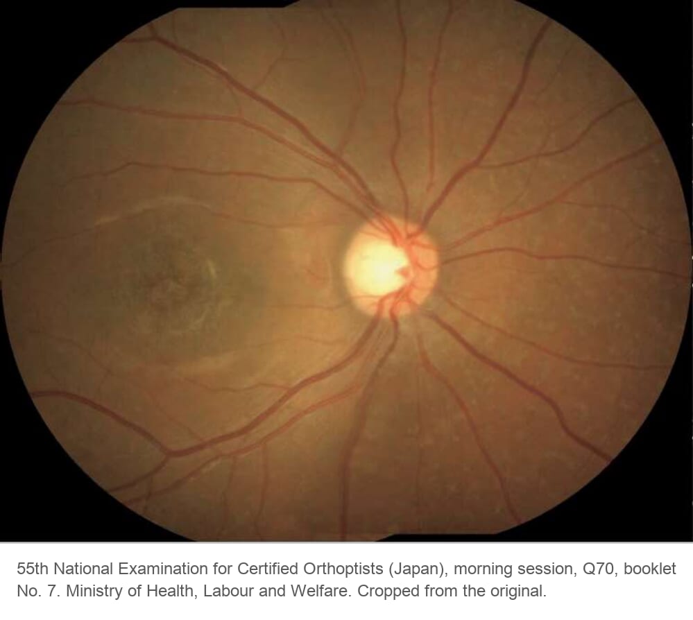Color fundus photograph of a 9-year-old boy with Stargardt disease: a dull, atrophic-looking macula; the flecks around the posterior pole are faint