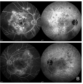 Four fundus angiograms from both eyes of a patient with acute VKH disease. The two left images are fluorescein angiograms with many bright spots pooling at the posterior pole. The two right images are indocyanine green angiograms with many scattered dark dots.