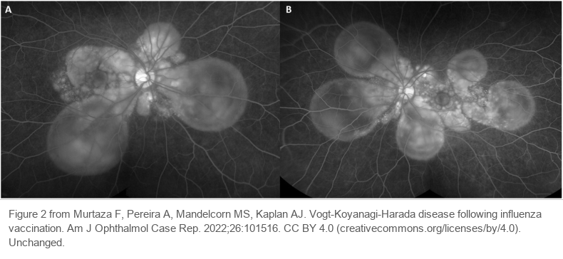 Late-phase fluorescein angiograms of both eyes. Rounded bright areas of pooled dye surround the optic disc like petals