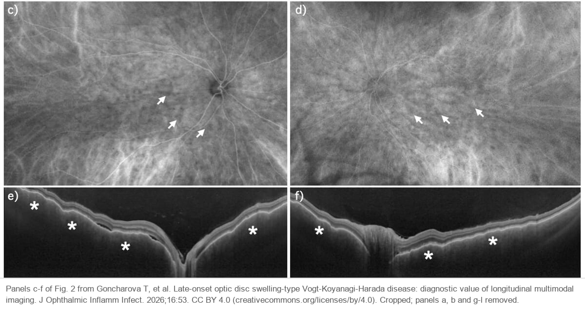 Indocyanine green angiograms of both eyes with small dark dots around the posterior pole, and optical coherence tomography of both eyes showing a thick, wavy choroid