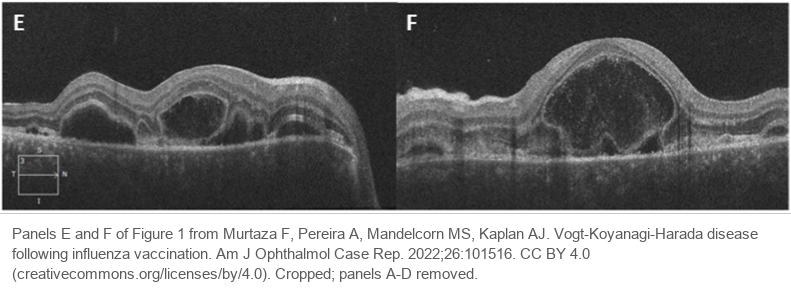 Optical coherence tomography of both eyes. Each shows a serous retinal detachment divided by thin walls into several pockets