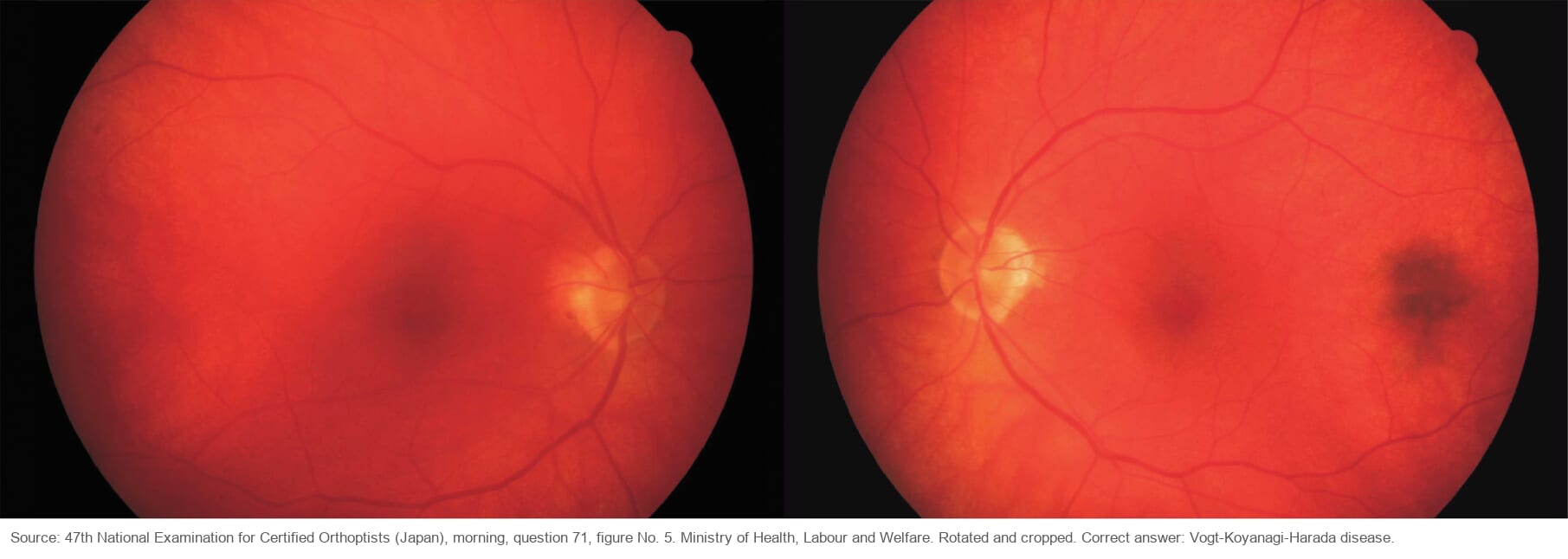 Fundus photographs of both eyes. The whole fundus is a deep orange-red, and the left eye has a dark pigment clump temporal to the macula