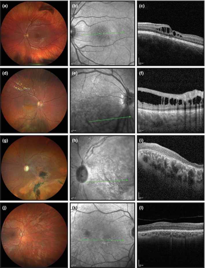 Four rows of images from four patients of different ages. Each row has a color fundus photograph, an infrared image and an OCT scan