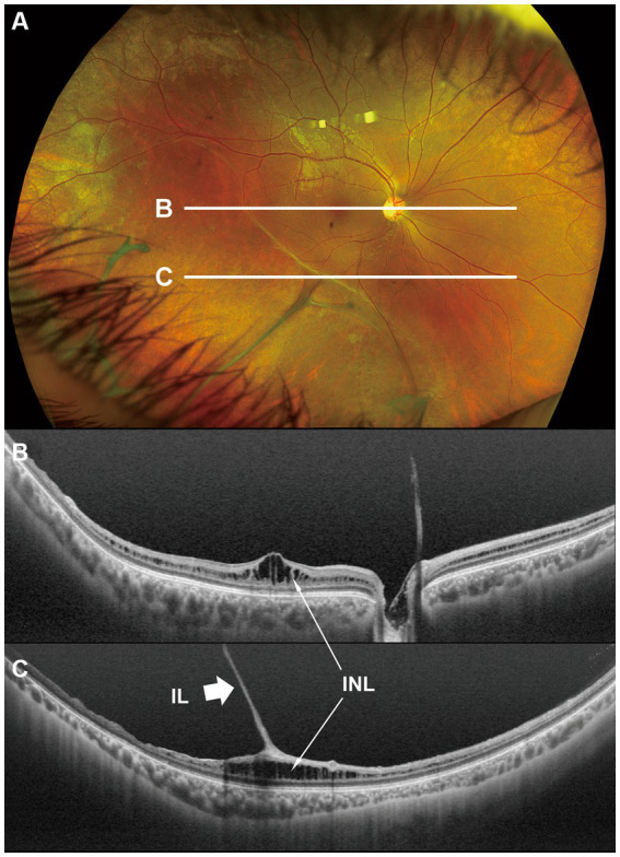 Wide-field fundus photograph with two scan lines, and two OCT scans below it